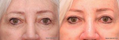 Laser Resurfacing Before & After Gallery - Patient 108566 - Image 1