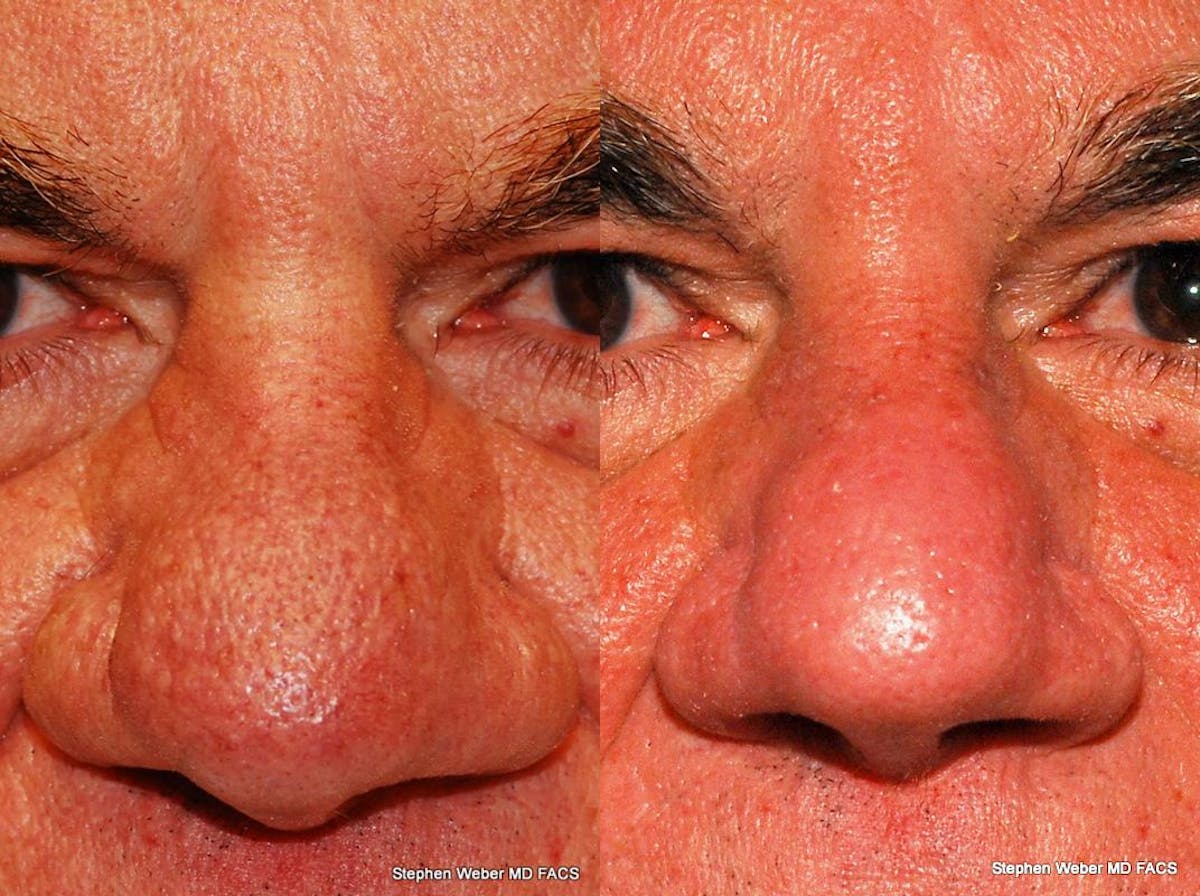 Laser Resurfacing Before & After Gallery - Patient 453138 - Image 1