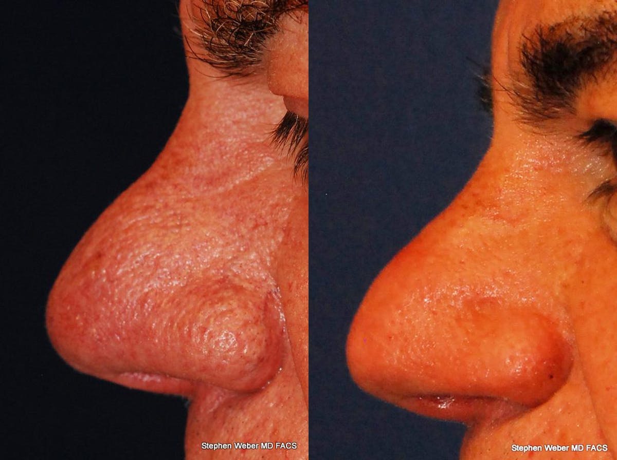 Laser Resurfacing Before & After Gallery - Patient 453138 - Image 2