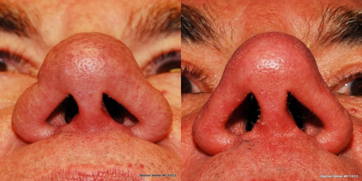 Laser Resurfacing Before & After Gallery - Patient 453138 - Image 3