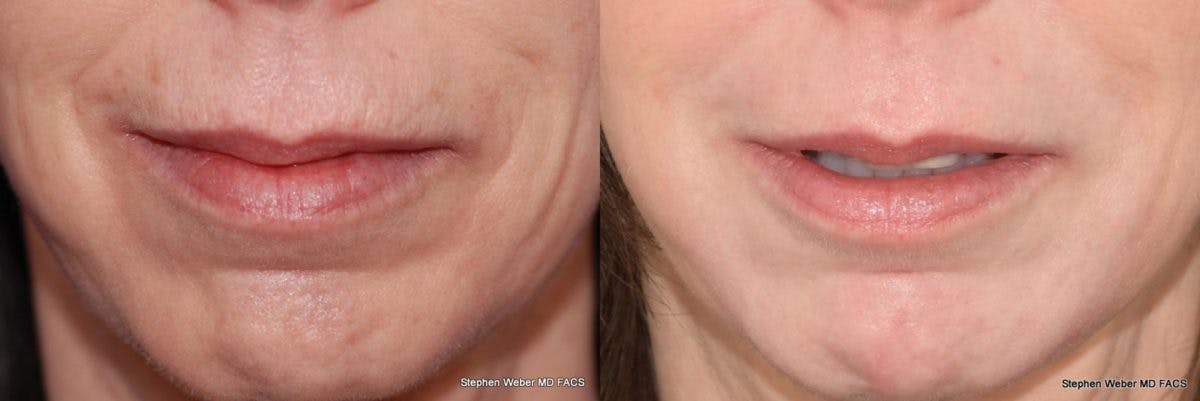 Laser Resurfacing Before & After Gallery - Patient 302003 - Image 1