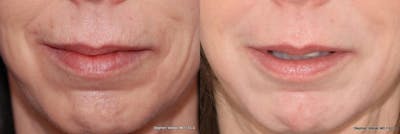 Laser Resurfacing Before & After Gallery - Patient 302003 - Image 1