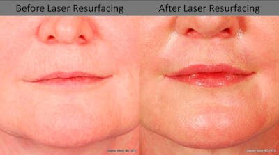 Laser Resurfacing Before & After Gallery - Patient 161674 - Image 1