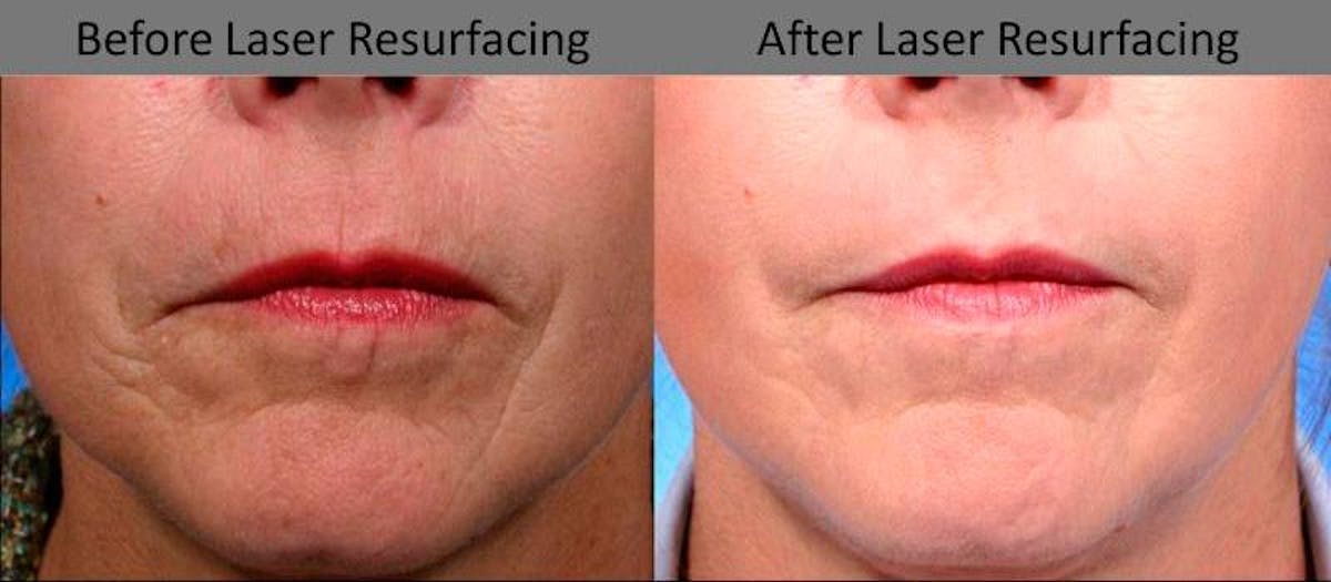 Laser Resurfacing Before & After Gallery - Patient 396545 - Image 1