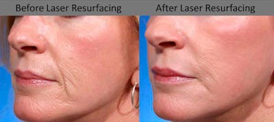 Laser Resurfacing Before & After Gallery - Patient 495174 - Image 1
