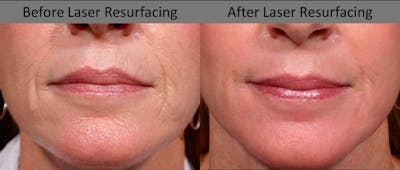 Laser Resurfacing Before & After Gallery - Patient 199897 - Image 1