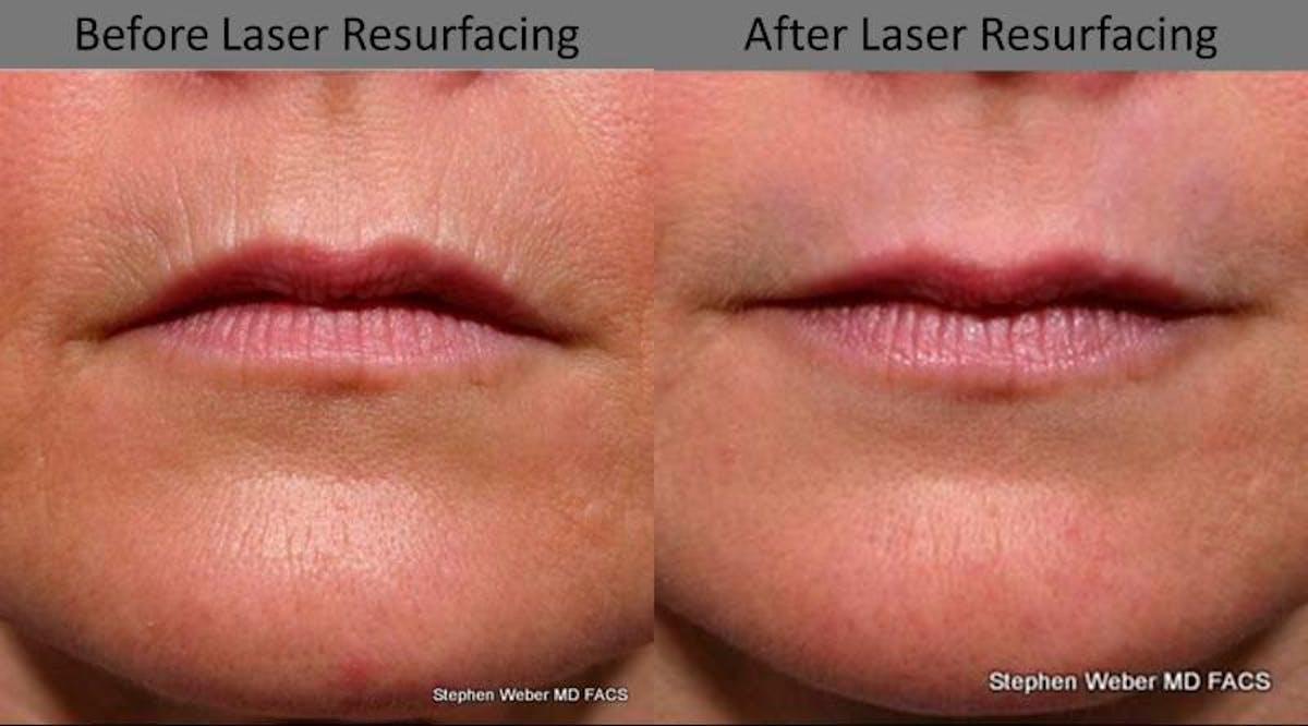 Laser Resurfacing Before & After Gallery - Patient 162539 - Image 1