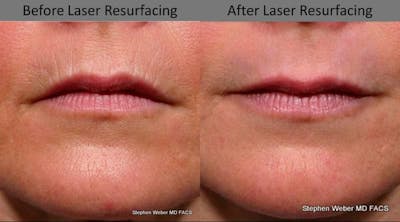 Laser Resurfacing Before & After Gallery - Patient 162539 - Image 1