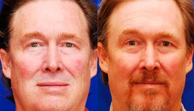 Laser Resurfacing Before & After Gallery - Patient 311633 - Image 1