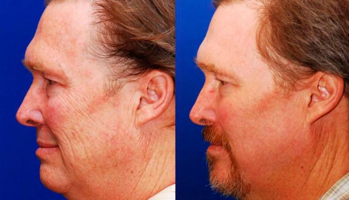 Laser Resurfacing Before & After Gallery - Patient 311633 - Image 2