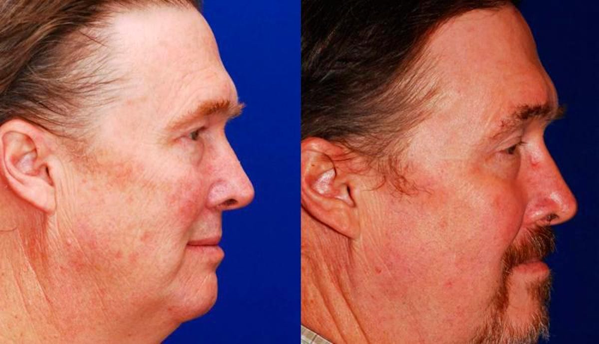 Laser Resurfacing Before & After Gallery - Patient 311633 - Image 3