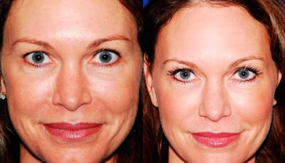 Laser Resurfacing Before & After Gallery - Patient 738683 - Image 1