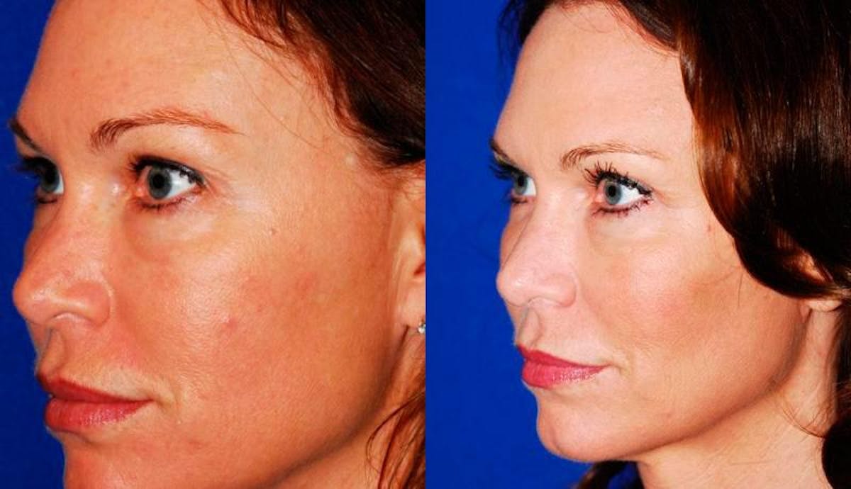 Laser Resurfacing Before & After Gallery - Patient 738683 - Image 2