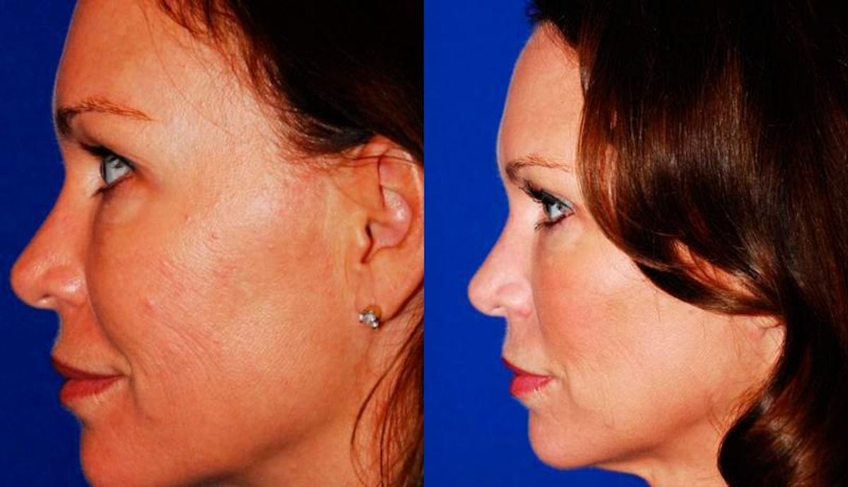 Laser Resurfacing Before & After Gallery - Patient 738683 - Image 3