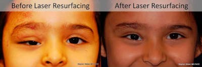 Laser Resurfacing Before & After Gallery - Patient 389533 - Image 1
