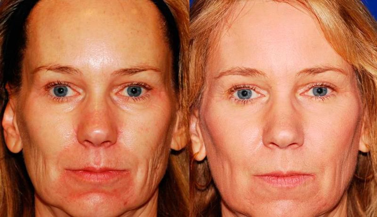 Laser Resurfacing Before & After Gallery - Patient 150945 - Image 1