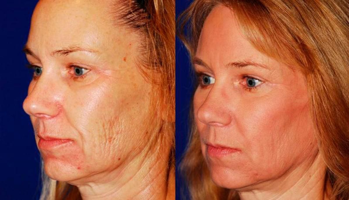 Laser Resurfacing Before & After Gallery - Patient 150945 - Image 2