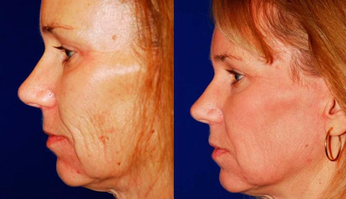 Laser Resurfacing Before & After Gallery - Patient 150945 - Image 3