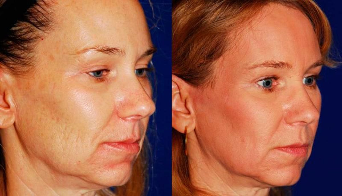 Laser Resurfacing Before & After Gallery - Patient 150945 - Image 4