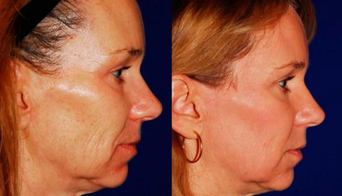 Laser Resurfacing Before & After Gallery - Patient 150945 - Image 5