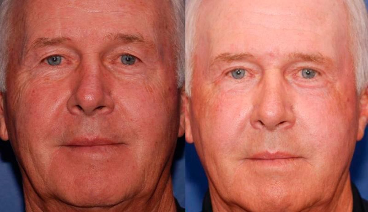 Laser Resurfacing Before & After Gallery - Patient 248801 - Image 1