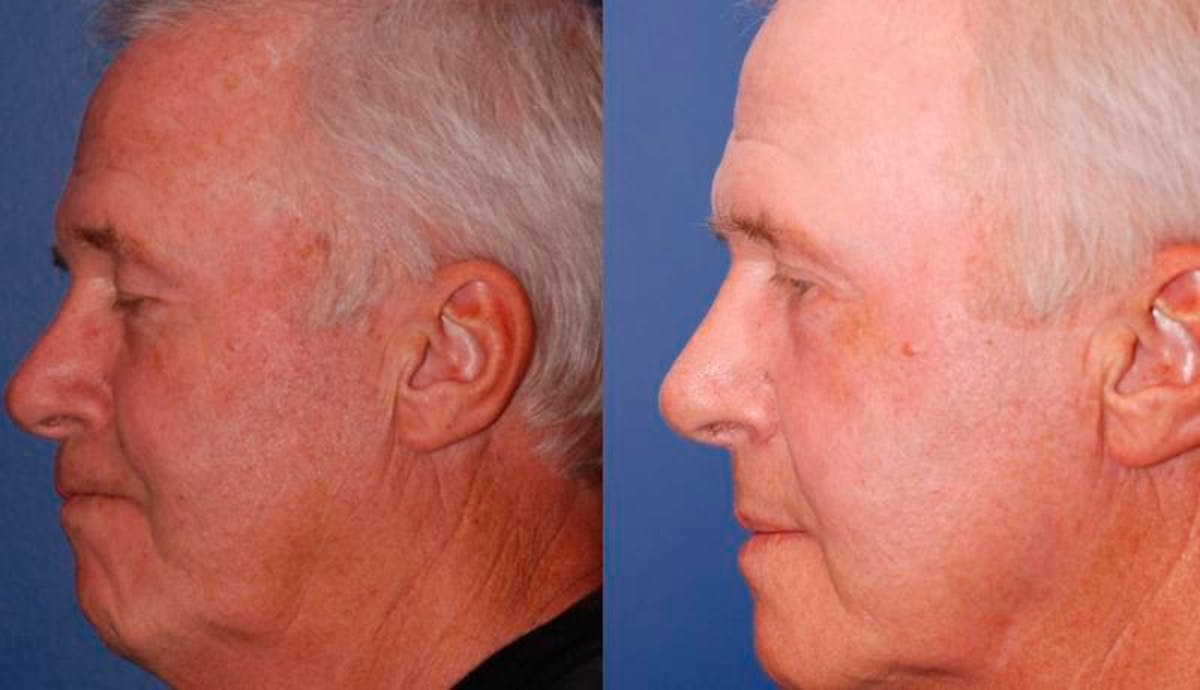 Laser Resurfacing Before & After Gallery - Patient 248801 - Image 2