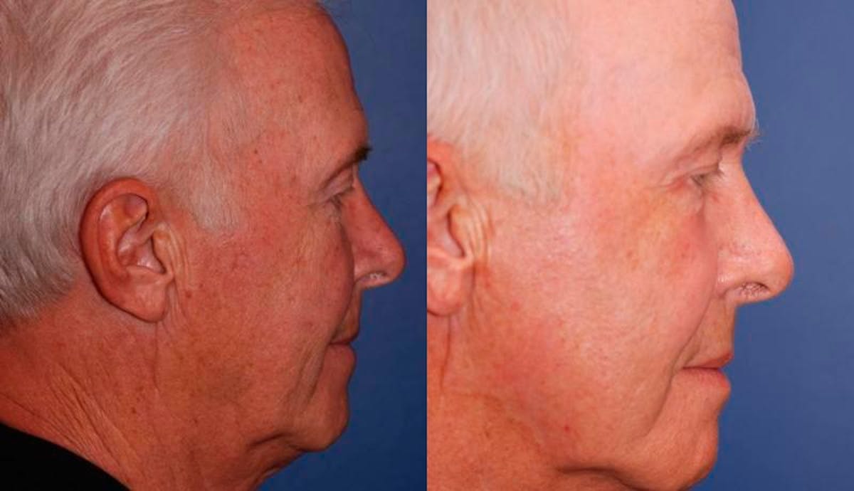 Laser Resurfacing Before & After Gallery - Patient 248801 - Image 3