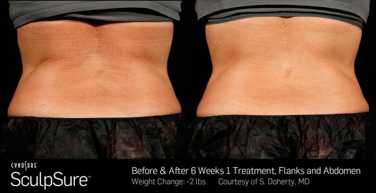 Sculpsure Before & After Gallery - Patient 224108 - Image 1