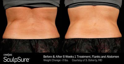 Sculpsure Before & After Gallery - Patient 224108 - Image 1
