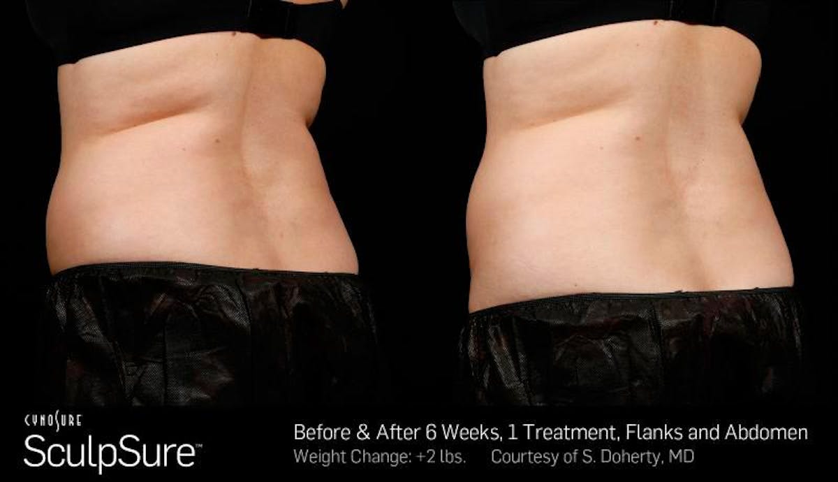 Sculpsure Before & After Gallery - Patient 704865 - Image 1
