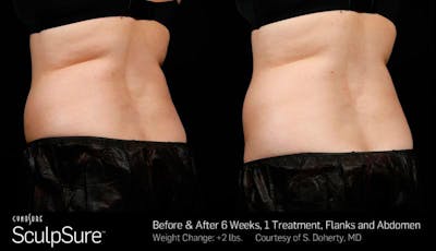 Sculpsure Before & After Gallery - Patient 704865 - Image 1