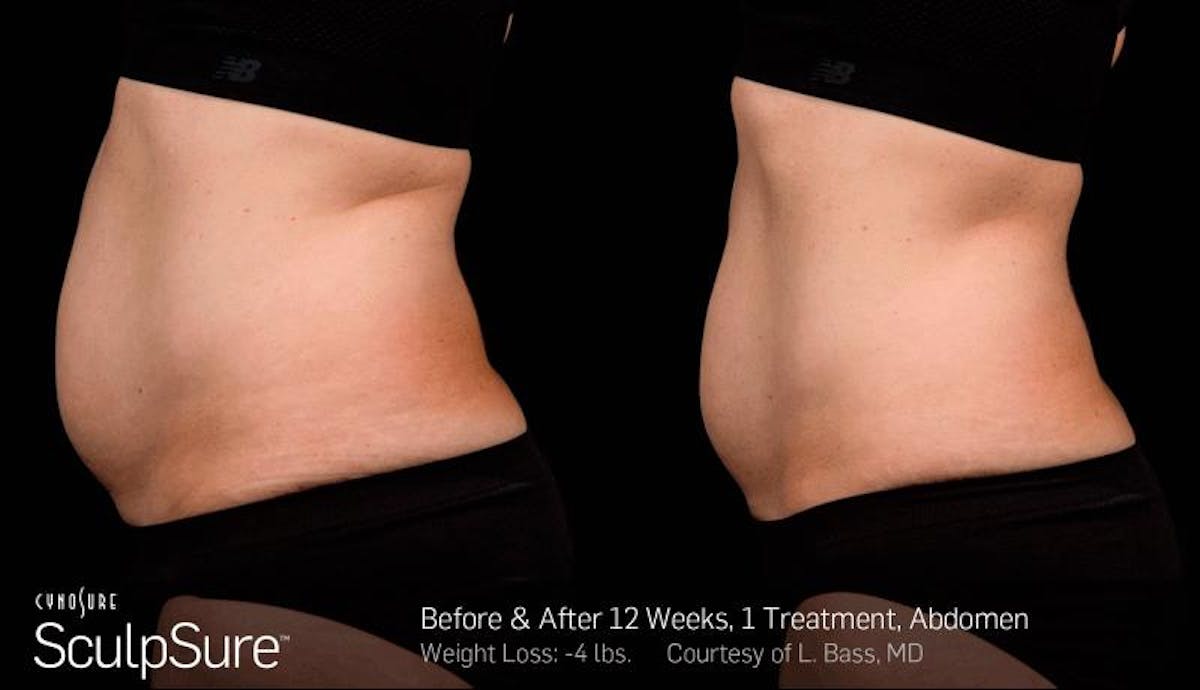 Sculpsure Before & After Gallery - Patient 704865 - Image 2