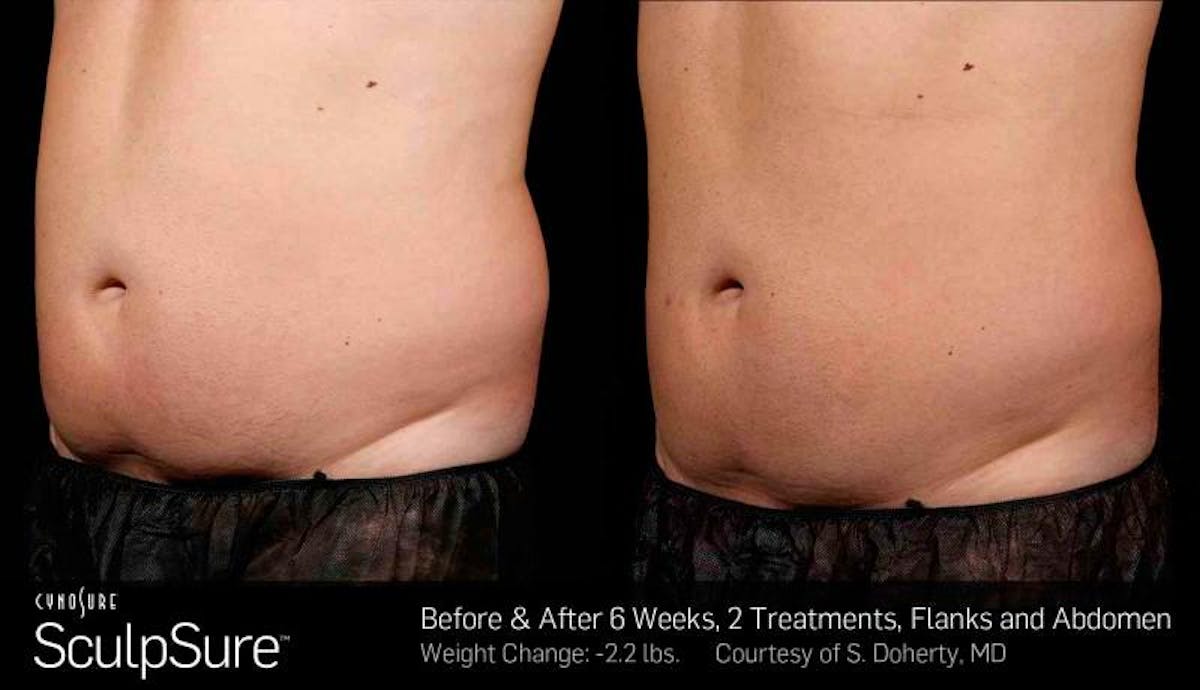 Sculpsure Before & After Gallery - Patient 233856 - Image 1