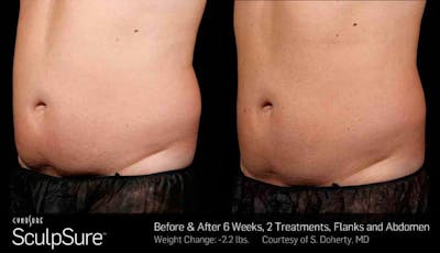 Sculpsure Before & After Gallery - Patient 233856 - Image 1