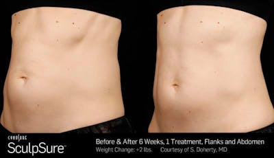 Sculpsure Before & After Gallery - Patient 155455 - Image 1