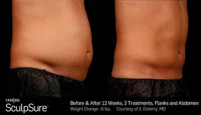 Sculpsure Before & After Gallery - Patient 339677 - Image 1