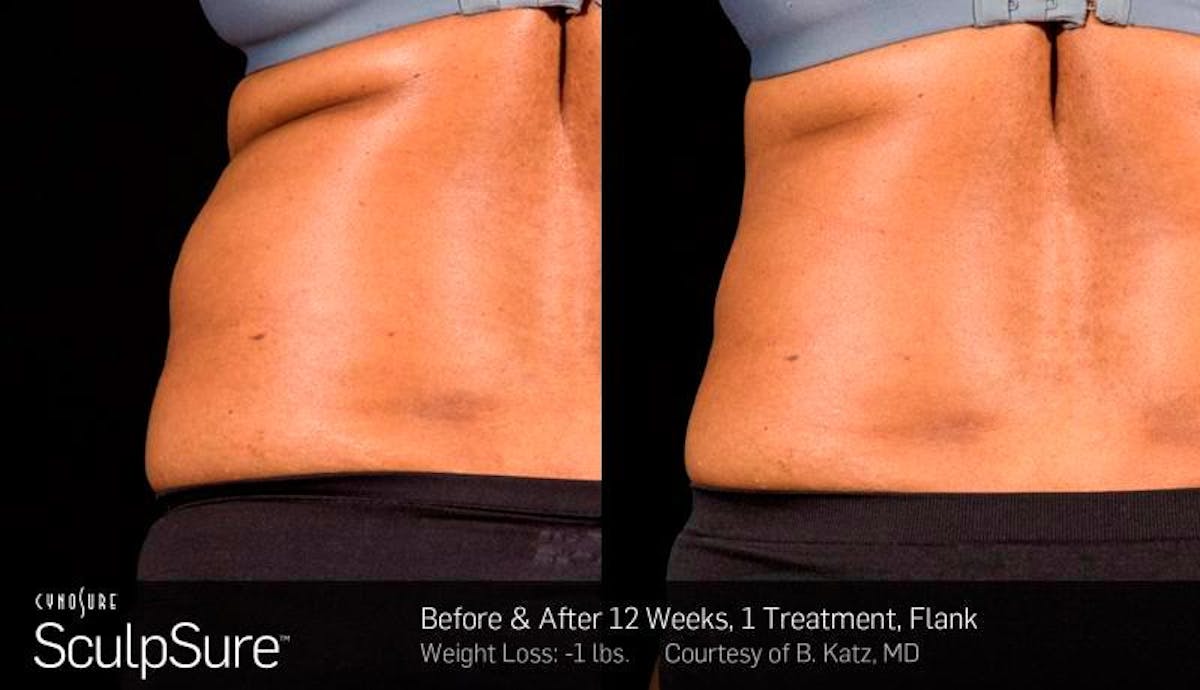 Sculpsure Before & After Gallery - Patient 427933 - Image 1