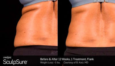 Sculpsure Before & After Gallery - Patient 427933 - Image 1