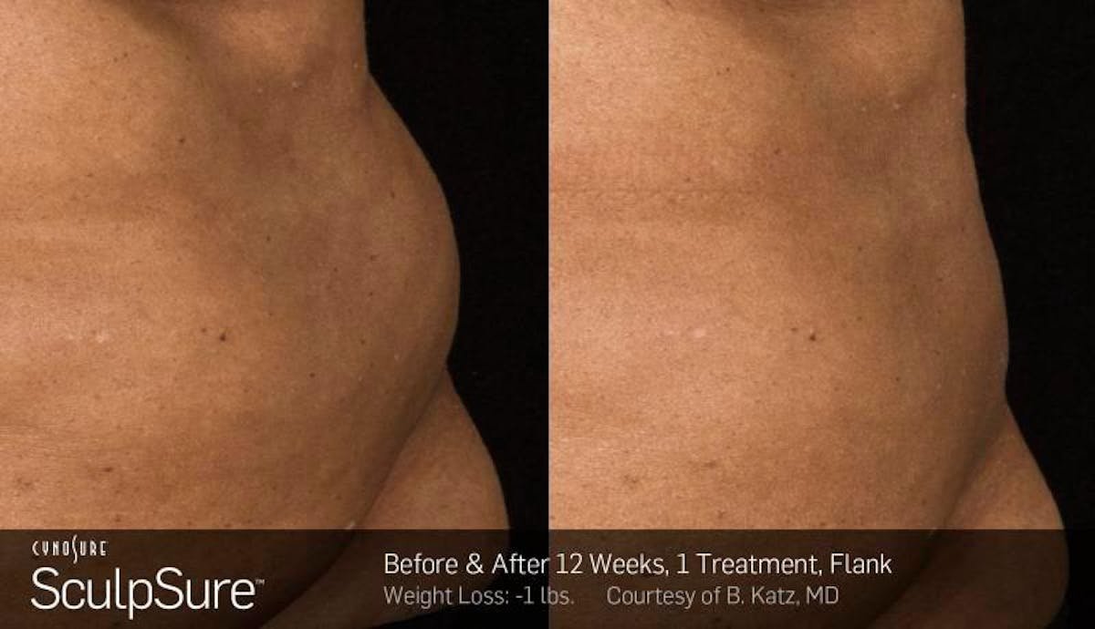 Sculpsure Before & After Gallery - Patient 106773 - Image 1