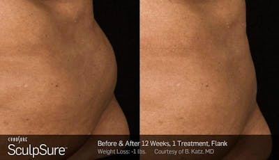 Sculpsure Before & After Gallery - Patient 106773 - Image 1