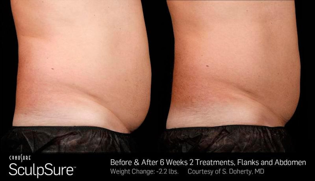 Sculpsure Before & After Gallery - Patient 181280 - Image 1