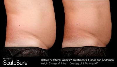 Sculpsure Before & After Gallery - Patient 181280 - Image 1