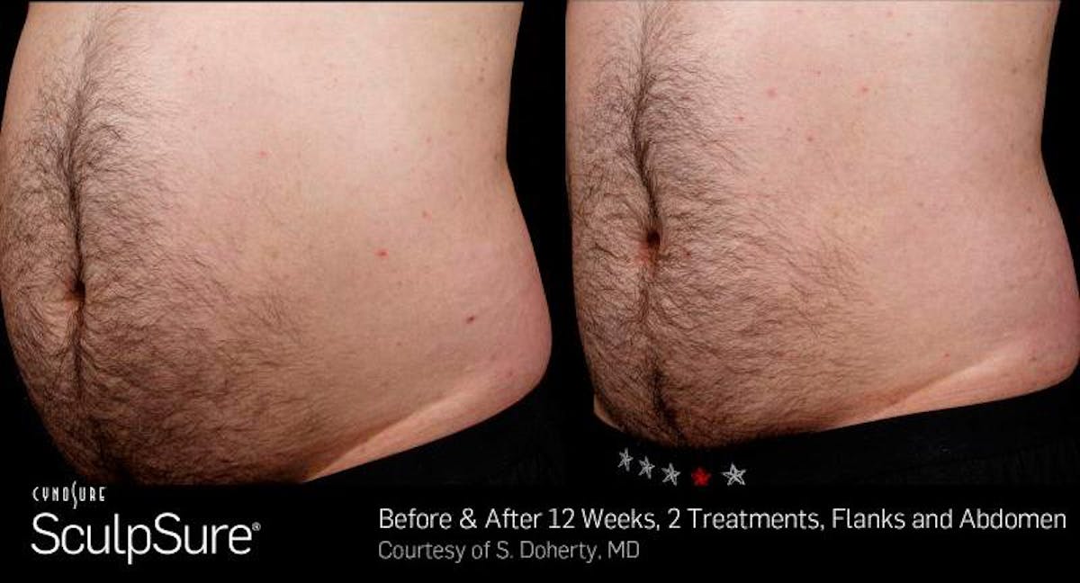 Sculpsure Before & After Gallery - Patient 264462 - Image 1