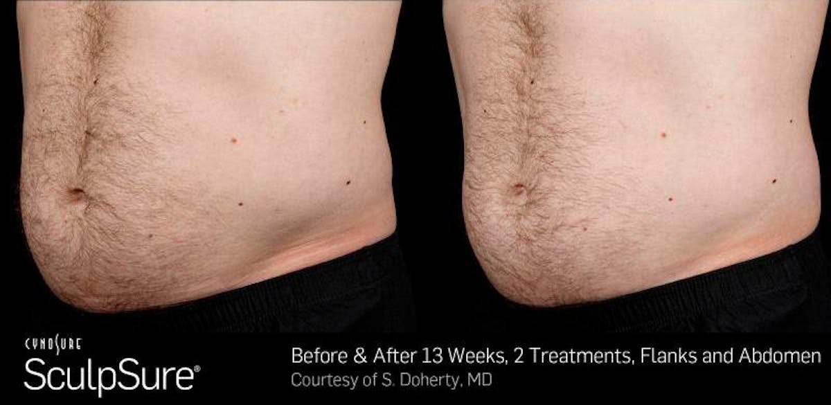 Sculpsure Before & After Gallery - Patient 112263 - Image 1