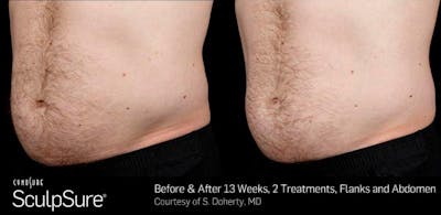 Sculpsure Before & After Gallery - Patient 112263 - Image 1