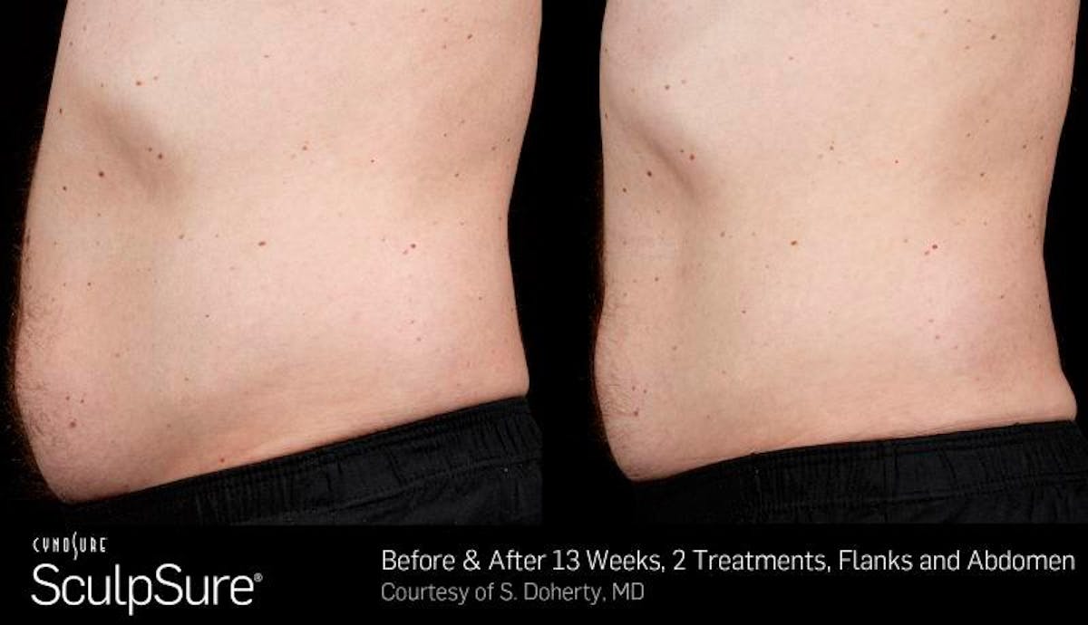 Sculpsure Before & After Gallery - Patient 203211 - Image 1