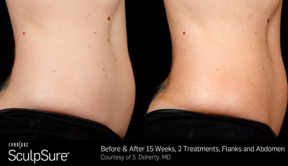 Sculpsure Before & After Gallery - Patient 203211 - Image 2