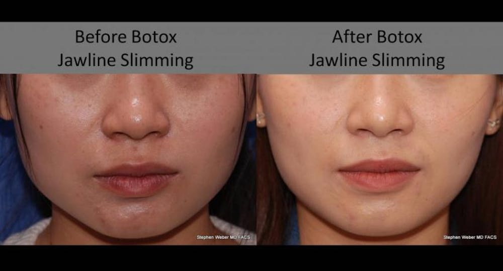Non-Surgical Jawline Shaping with Botox Non-Surgical Jawline Shaping with Botox