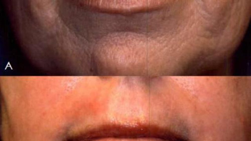 J Plasma Hand Denver Before and After, CO J Plasma Hand Denver Before and After, CO