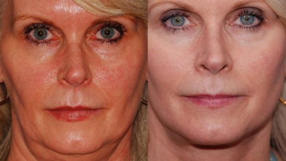 How can you tighten your neck? Denver, CO How can you tighten your neck? Denver, CO